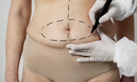 Chirurgie esthétique du ventre